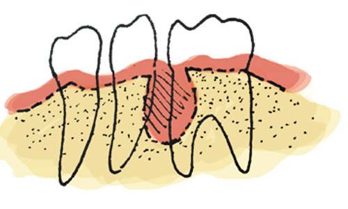 Imagen de un problema periodental. Es uno de los muchos tratamientos que se realizan en la clínica dental Clínica Herrero en Valencia.