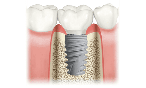 Imagen de un implante dental. El implante dental es unos de los muchos tratamientos que se realizan en la clínica dental Clínica Herrero en Valencia.