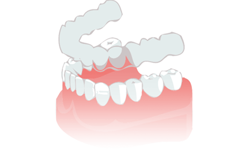 Imagen de protector para pacientes que padecen bruxismo. El bruxismo es uno de los problemas que se tratan en la clínica dental Clínica Herrero en Valencia.